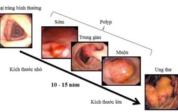 Người đàn ông ở Phú Thọ phát hiện mắc ung thư trực tràng từ một dấu hiệu nhiều người Việt bỏ qua