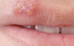 Cách phòng tránh lây nhiễm Herpes sinh dục