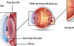 6 bước ngăn ngừa tăng nhãn áp gây hại thêm cho thị lực