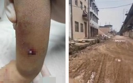 Cậu bé 4 tuổi nguy kịch do chó cắn, chủ vật nuôi tìm cách che giấu