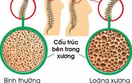 Mối nguy hiểm tiềm ẩn khi phụ nữ thiếu canxi