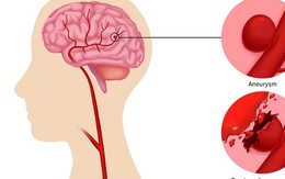 Đau đầu đột ngột coi chừng phình động mạch não