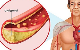 Tại sao thanh niên từ 20 tuổi trở lên nên kiểm tra cholesterol 5 năm/ lần?