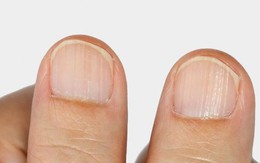 Màu sắc khác thường ở móng tay, chân biểu hiện bệnh gì?