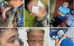 Hà Nội: Nhiều học sinh trường tiểu học Hải Bối mẩn ngứa, đau rát mắt sau khi đi học về