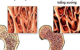 Xoa bóp bấm huyệt có lợi ích gì với người loãng xương?