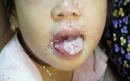 Bé gái bị nhiễm trùng nặng, miệng không thể ăn uống do mắc thủy đậu