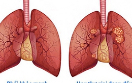 Cách tập luyện ở người mắc bệnh ung thư phổi