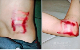 Thanh niên 29 tuổi ở Lạng Sơn bị sét đánh ngất ngay trong phòng ngủ, lúc nửa đêm