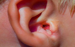 Biểu hiện viêm tai ngoài và cách phòng tránh