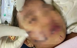 Đang chơi, bé gái 11 tuổi ở Phú Thọ bất ngờ bị chó hàng xóm cắn trọng thương vùng đầu, gáy