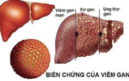 Người đàn ông ở Hà Nội men gan cao gấp 34 lần vì dùng thuốc theo thói quen của rất nhiều người Việt