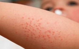 Triệu chứng nhận biết bệnh giảm tiểu cầu