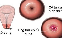 Người bệnh ung thư tử cung nên vận động như thế nào?