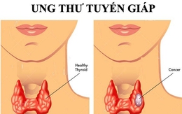 K tuyến giáp có nguy hiểm không và điều trị thế nào?