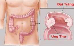 2 mẹ con cùng mắc ung thư thừa nhận một sai lầm nhiều người Việt mắc phải