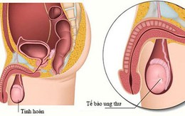 Bé trai 11 tuổi đã mắc ung thư tinh hoàn, chuyên gia cảnh báo dấu hiệu phát hiện sớm bệnh