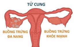 Cô gái 18 tuổi ở Hà Nội bất ngờ phát hiện buồng trứng đa nang từ dấu hiện nhiều phụ nữ Việt bỏ qua