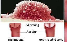 Người phụ nữ 31 tuổi ở Quảng Ninh phát hiện ung thư cổ tử cung từ dấu hiệu nhiều người Việt mắc phải