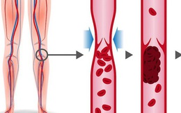7 dấu hiệu cảnh báo sớm cục máu đông, phòng ngừa như thế nào?