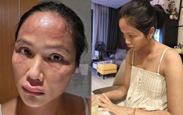 Hoa hậu H'Hen Niê bất ngờ chia sẻ mặt sưng nề, mẩn đỏ sau sinh con, căn bệnh cô mắc nguy hiểm thế nào?