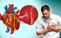 Người đàn ông 52 tuổi ở Quảng Ninh đột ngột lên cơn nhồi máu cơ tim trong tình huống nguy cấp, bác sĩ cân não xử trí