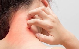 Mẹ bỉm cần cẩn trọng với mề đay sau sinh: Đừng chủ quan với những vết nổi ngứa