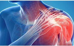 Viêm khớp vai: Cảnh giác với dấu hiệu nhiều người Việt bỏ qua