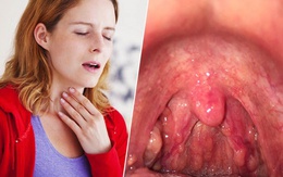 Cách phòng ngừa bệnh viêm họng cấp lúc giao mùa đơn giản mà hiệu quả nhất