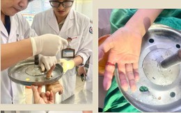 Nghịch dại, bé 12 tuổi bị suýt mất ngón tay vì chiếc ghế xoay