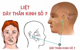 Thanh niên 23 tuổi ở Hà Nội méo miệng, liệt dây thần kinh số 7 thừa nhận mắc sai lầm này khi tắm đêm