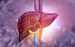 Người đàn ông 49 tuổi may mắn phát hiện bệnh lý gan nguy hiểm nhờ 1 việc mà rất nhiều người Việt bỏ qua