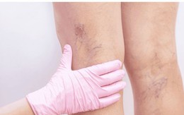 Bí quyết bảo vệ đôi chân khỏi suy tĩnh mạch chi dưới