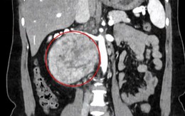 Nhầm lẫn đau lưng do tập thể thao, người phụ nữ đi khám phát hiện khối u 'khổng lồ'
