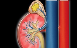 Thanh niên 16 tuổi bị tăng huyết áp kéo dài, bác sĩ tìm ra nguyên nhân bất ngờ