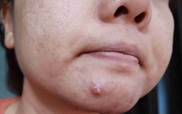 Cách xử lý mụn bọc sưng to an toàn, hạn chế thâm sẹo