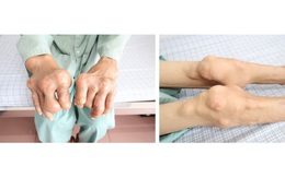 Người đàn ông 43 tuổi bị biến chứng bệnh gout nặng, thừa nhận 1 sai lầm nhiều người Việt mắc phải
