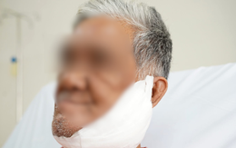 Người đàn ông 6 năm không dám soi gương vì nẹp vít lòi ra khỏi mặt