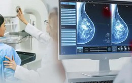 Phát hiện sớm ung thư vú nhờ ứng dụng AI trong chụp nhũ ảnh tầm soát