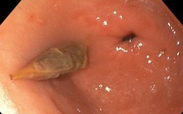 Ăn yến chưng táo đỏ, người phụ nữ 52 tuổi ở Quảng Ninh nhập viện gấp vì bất cẩn