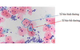 Đi khám xương khớp nghĩ bệnh tuổi trung niên, người phụ nữ 52 tuổi bất ngờ phát hiện tiền ung thư cổ tử cung
