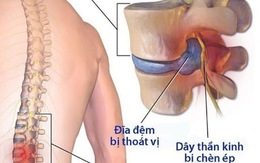 Thoái vị đĩa đệm cột sống lưng: Cần làm gì để hết đau?