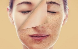 Cách chăm sóc da mùa đông phòng nứt nẻ