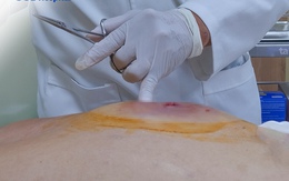 Người đàn ông 41 tuổi phát hiện bệnh tiểu đường từ dấu hiệu cảnh báo bệnh, nhưng người Việt thường bỏ qua