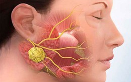 Mặt tụ nhiên mất cân đối, người phụ nữ 38 tuổi đi khám bất ngờ phát hiện ung thư