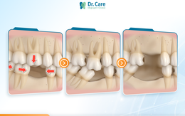 Có nên trồng răng số 6 (răng cấm) khi mất răng, chi phí có đáng với chất lượng?