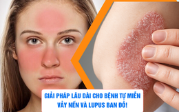 Giải pháp lâu dài cho bệnh tự miễn vảy nến và lupus ban đỏ!