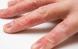 Làm cách nào để khắc phục da tay khô nứt nẻ vào mùa đông?