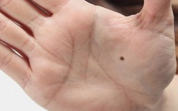 4 vị trí nốt ruồi phú quý, ai sở hữu đều có cuộc đời giàu sang, phúc lộc đủ đầy