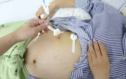 Đau bụng bất thường, thai phụ 32 tuần tuổi bất ngờ phát hiện viêm ruột thừa biến chứng nguy hiểm